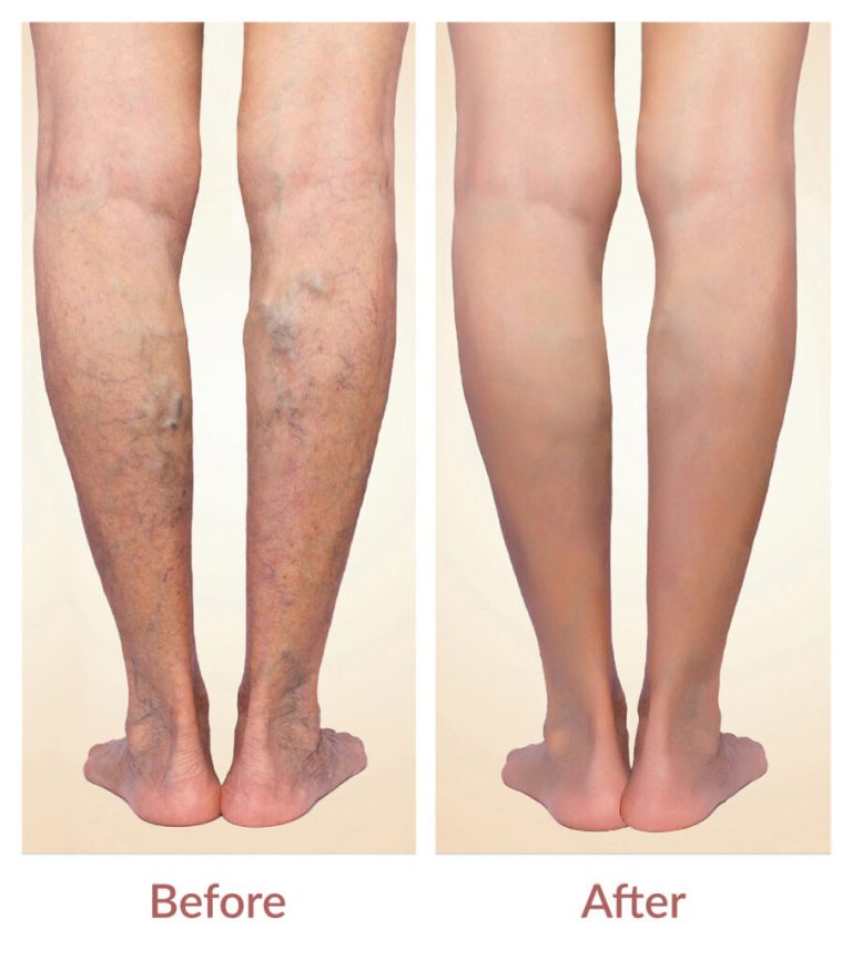 Spider Veins Treatment - Before & After