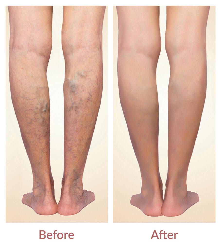 Spider Veins Treatment Treatment - Virtue Vein & Lymphatic Center