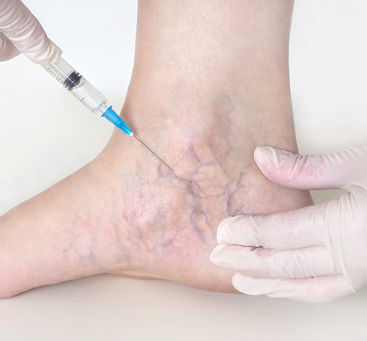 photo of SclerotherapyTreatment