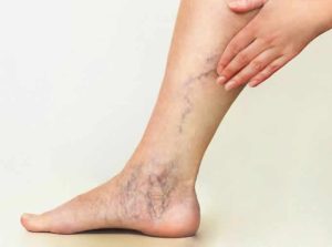 Vein disease